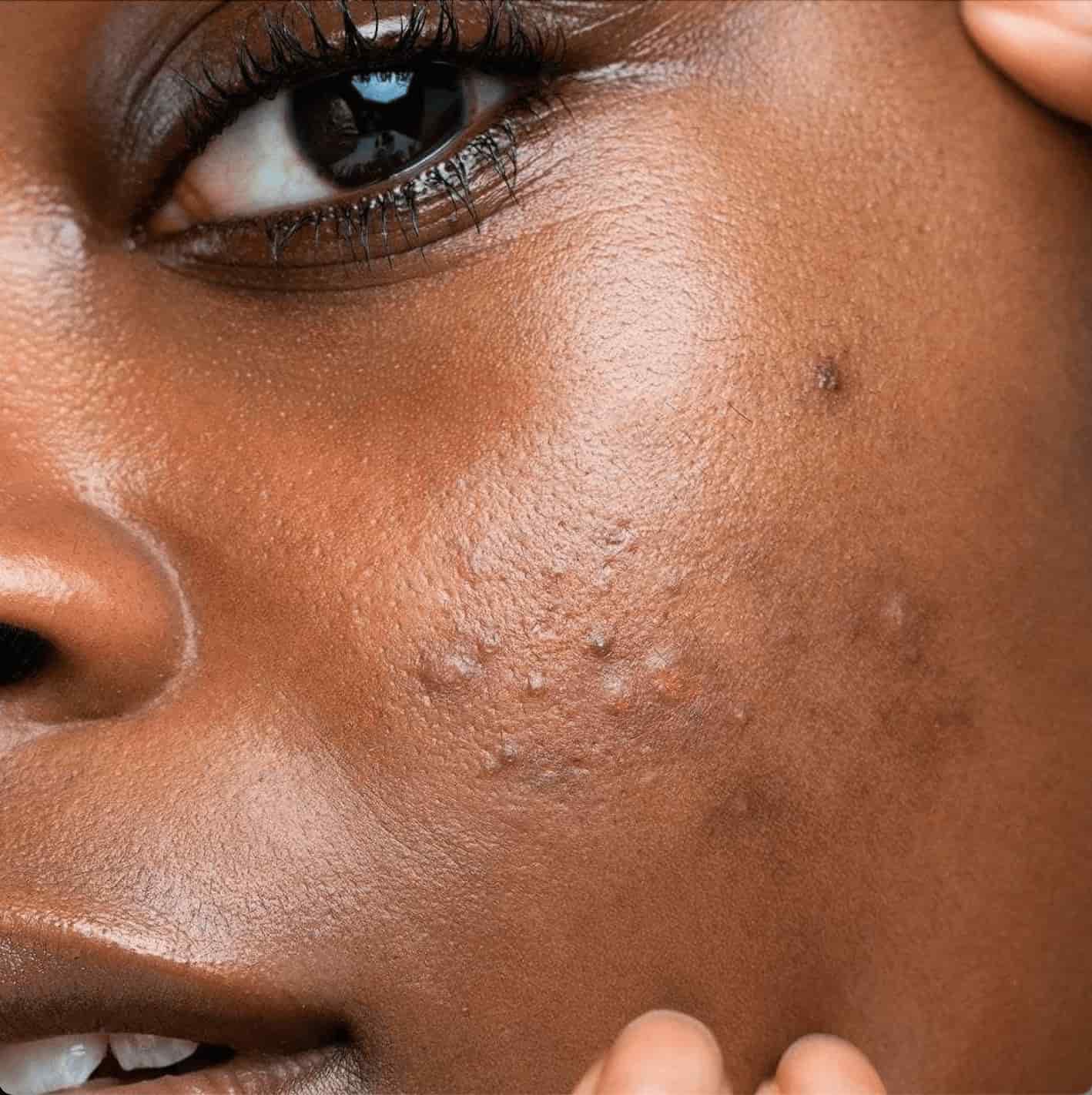 Soins anti-acné ACN'OYA